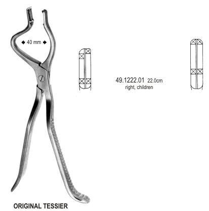 Tessier Disimpaction Fcps right child 22cm