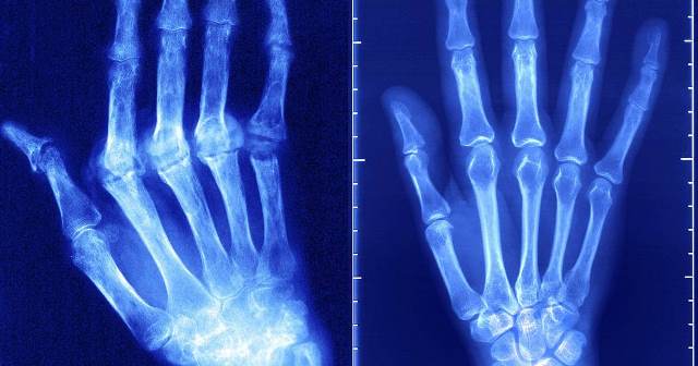 RHEUMATOID ARTHRITIS hand